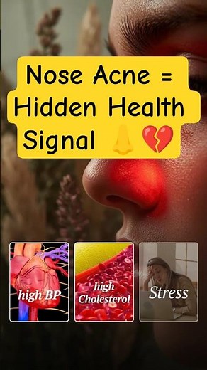Skincare Tips: What Your Nose Pimples Say About Your Health