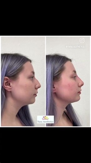 Side profile transformations that still look like you 👃✨