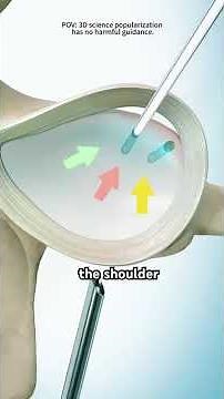 How Arthroscopic Bankart Repair Surgery Is Performed #BankartRepair #orthocare