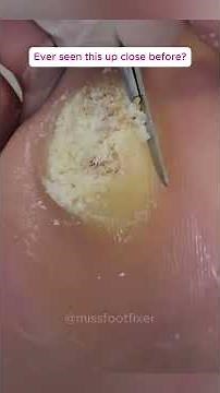 Super big verruca shave down 👣😳