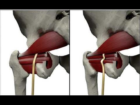 Sciatic Nerve Dynamic Ultrasound - Includes Obturator Gemellus Piriformis Quadratus Femoris