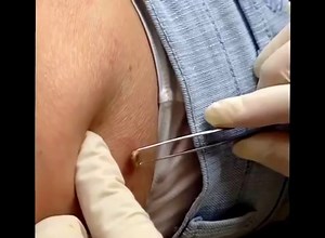 THIS Is What It's Like To Assist Dr. Pimple Popper In The Operating Room