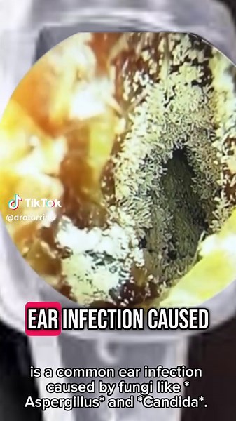 Understanding Otitis and Effective Ear Cleaning Methods