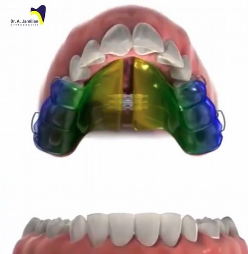 Upper Jaw Expansion with Removable Orthodontic Appliance | 3D Animation #expansion #orthodontics