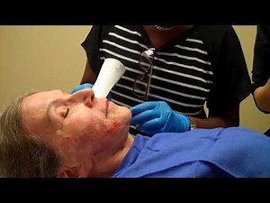 Micro Needling Profound Treatment | Michigan Plastic Surgeon Dr. Michelle Hardaway