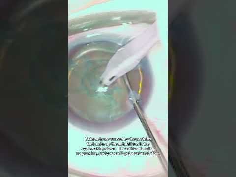 Refractive lens exchange (6 minute surgery that can last 100 years)