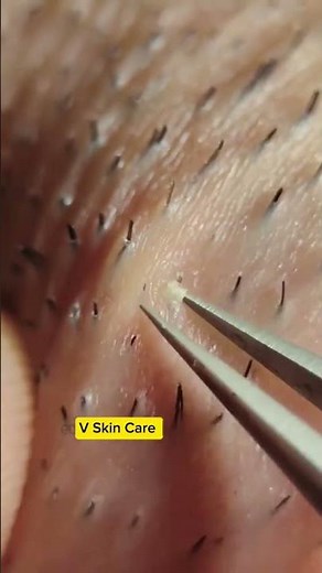 CA Spa | Acne Treatment • Facial Spa • Skincare