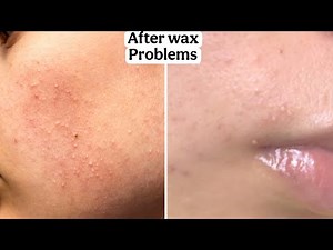 How to get rid of itching and small bumps | Wax after care | After wax Problems