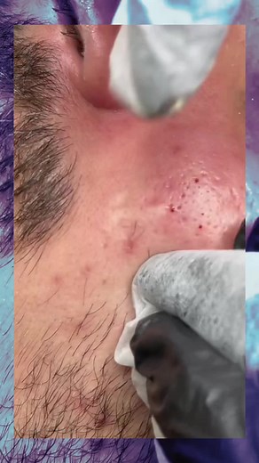 the pimple crusher su TikTok