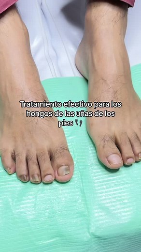 Tratamiento efectivo para los hongos de las uñas de los pies 👣