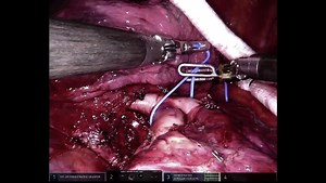 Robotic-assisted left lower-lobe pulmonary lobectomy: Eleven steps