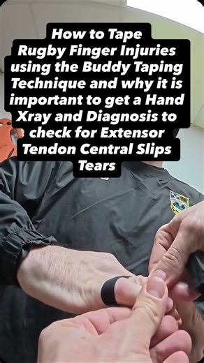Chris Jenkins | Rugby Injury Sports Physiotherapist on Instagram: "🏉Rugby Finger Injury + Taping 🏉👇 PIP joint injuries are common and can be more than “just a jammed finger”. What can happen: • Soft tissue sprains • Volar plate injuries • Collateral ligament tears • Possible fractures (always consider X-ray) • Risk of boutonnière deformity • Watch for central slip extensor tendon injury / rupture 👀 Key clinical point for rugby: If a player can’t actively extend the PIP joint or there’s suspi