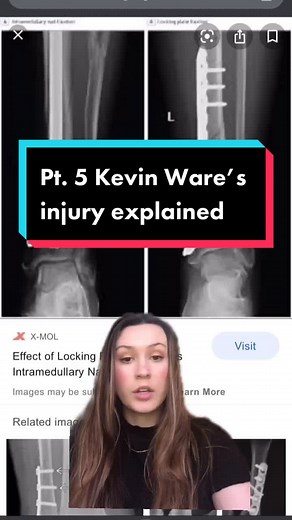 #greenscreen PT. 5 Kevin Ware’s injury explained! Rods! #orthopedicsurgeon #orthopedics #biomedicina #basketball