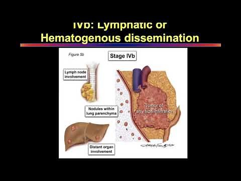 Management of Invasive Thymomas