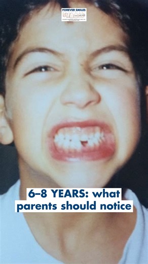 Most parents think orthodontic care starts with braces in the teen years - but the most valuable check actually happens much earlier. Around ages 6–7, permanent teeth begin to come in, and the jaws are actively growing. This is the best time to spot developing bite problems that can be guided, not just fixed later. An orthodontic evaluation at this age can help: • Create space for incoming teeth before crowding happens • Prevent crossbites that can cause a range of functional, skeletal, and dent