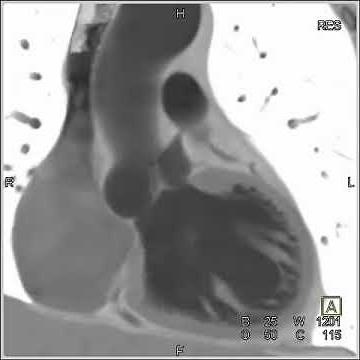 Cardiac: Dilated aortic root and sinuses of Valsalva (5 of 10)