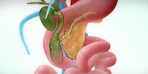 Resection of a Type III choledochal cyst - TVASurg - The Toronto Video Atlas of Surgery