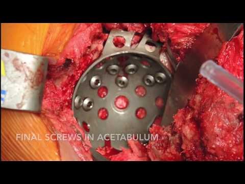 Reconstructing Pelvic Discontinuity and Severe Acetabular Bone Loss in Revision Hip Arthroplasty