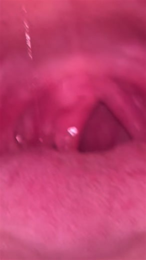 Understanding Uvulitis: Symptoms and Help