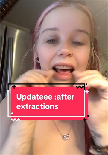 DENTURE UPDATE 💗💗 will be making a separate video of MY pros & cons and also the process i went through during extractions and post op healing!! #dentures #denturegang #denturesatayoungage #newsmile #loveyourself