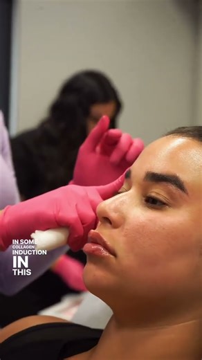 Did you know that PDO threads can benefit everyone?! 👀 PDO threads are used to lift certain areas