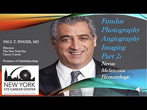 Ophthalmic Photography and Angiography Part 2: Choroidal Nevus, Melanoma and Hemorrhage