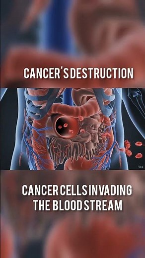 journey of metastatic cancer cells: How cancer spreads through the Body