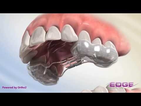 Rapid Palatal Expander (RPE)