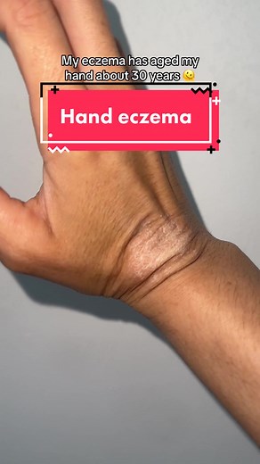 I’ve got this patch of #eczema on my hand which refuses to go away. It’s dry, crusty & cracks 😫 #handeczema #eczemarash #eczemaflareup #eczemawarriors #eczemaawareness