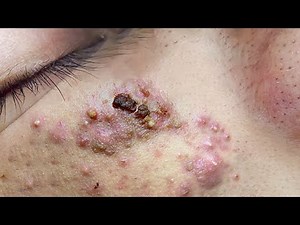 Suri Job #661: Great Inflamed Acne Extraction