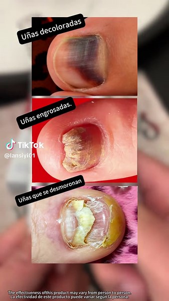 This pen can help you ugly nail!!💅💅💅💅✨✨✨#yellownails #nailfungus #nailcare #nail #tiktokshopblackfriday #nailtok #toenail #tiktokshopcybermonday