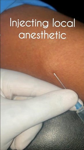 removing jadelle contraceptive implant