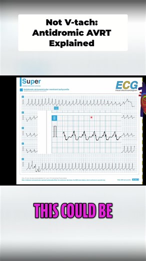 Mistaken for V-tach, but it's antidromic AVRT! ECG analysis showing wide QRS complexes. Avoid calcium channel blockers; opt for cardioversion. #ECG #Cardiology #MedicalEducation #AVRT #VTach
