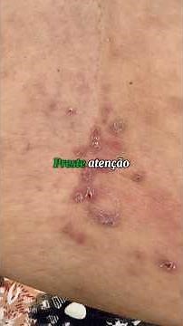 Psoriasis is not just skin blemishes.