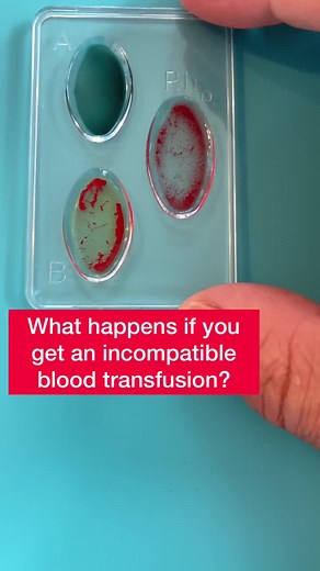 RED BLOOD CELL AGGLUTINATION UNDER THE MICROSCOPE. #fyp #biology #biologia #biologist #drbioforever #bloodtype