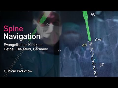 Spine navigation software amplifies surgeon’s skill and provides additional insights