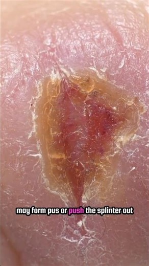“Tiny Splinter, Big Pain: What Happens When Something Gets Stuck Under Your Skin!” 😱