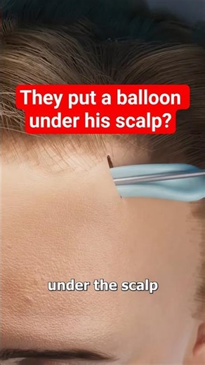 They put a balloon under his scalp? #shorts