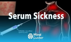 Mind Luster - Learn Serum Sickness Pathophysiology Symptoms Causes Treatment Animation