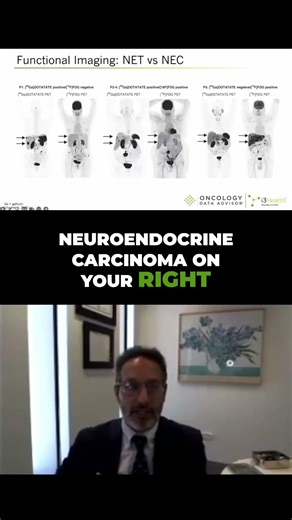Neuroendocrine Tumor Spectrum: Gallium68 vs FDG PET Scans