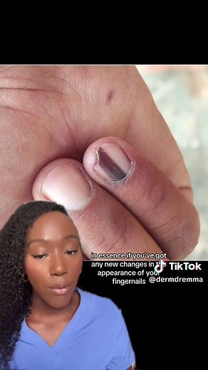 Replying to @Ketsia Most cases of brown fingernails are nothing to worry about, but if you have any concerns it’s safest to get it checked out! #brownfingernails #brownnails #melanonychia #subungualmelanoma #melanoma #cancerblackskin