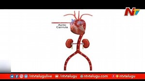 What Is ECMO Treatment for Coronavirus? #EcmoTreatment #Coronavirus #Covid19 #ntvtelugu #NTVNews #ntv | Ntv Telugu