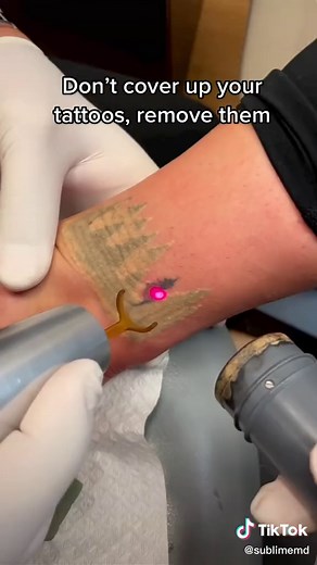 This client covered up an old tattoo but decided they want them both gone now 🔥 #derm #medspa #skin #tattooremoval #AmazonVirtualTryOn #MakeASplash
