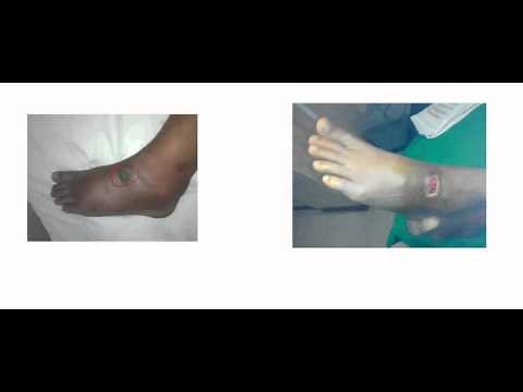 infected corn of the foot.avi