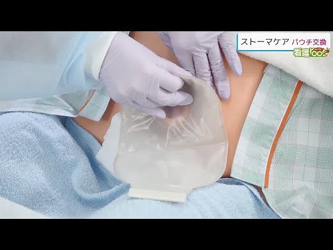 パウチ交換 ／ 監修 杏林大学