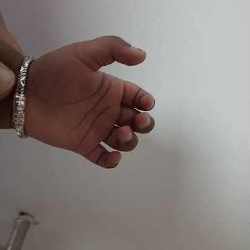 trigger thumb in children