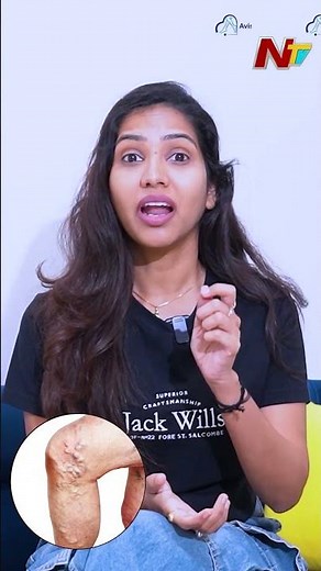 Advanced Laser Treatment For Varicose Veins In Avis Vascular Centre | NTV Telugu