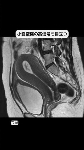 Endometrial polyps #radiology #imaging #shorts