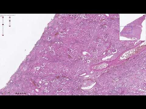 Benign Nephrosclerosis - Histopathology