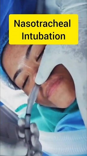 Nasotracheal Intubation